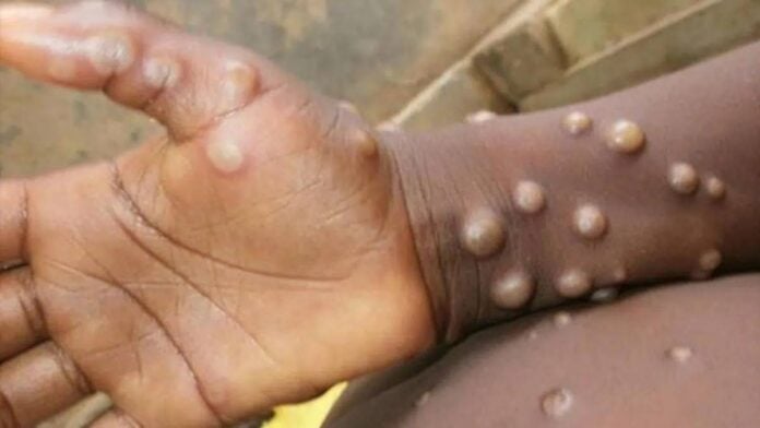 variole-du-singe La variole du singe