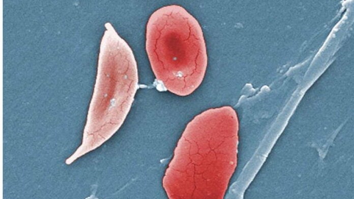 Drepanocytose Globule rouge falciforme (pâle, à gauche), typique de la maladie Drepanocytose
